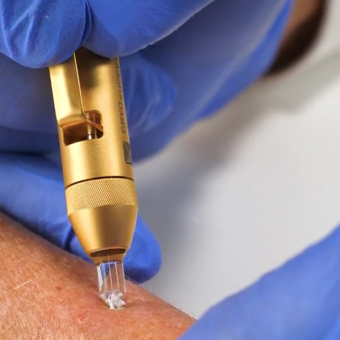 Clinician holding CryoSuccess